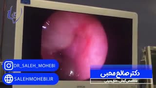 جراحی پولیپ بینی