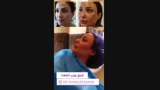 مدلینگ صورت برای تزریق چربی