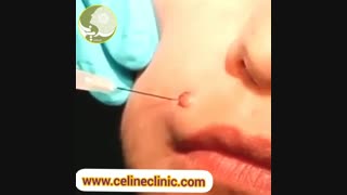 فیلم برداشتن خال صورت