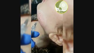 کربوکسی تراپی صورت تزریق چربی