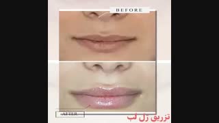 فیلم تزریق ژل لب لیزر مو