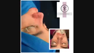فیلم واقعی جراحی بینی