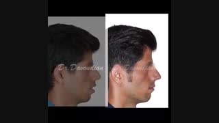 تاثیر ارتودنسی روی لب ها | دکتر داودیان