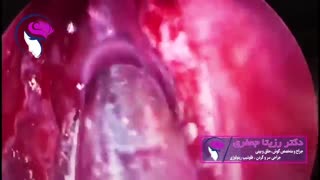فیلم جراحی واقعی آندوسکوپی مجرای اشکی