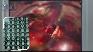 کاهش شنوایی گوش چپ و عدم تعادل