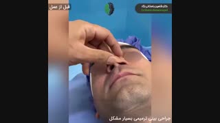 جراحی ترمیمی بینی برای افزایش طول بینی کوتاه | دکتر باستانی نژاد