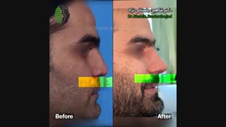 صحبت های دکتر باستانی نژاد درباره روش ابداعی در درمان بینی کوتاه
