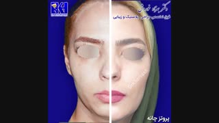 نمونه کار پروتز چانه