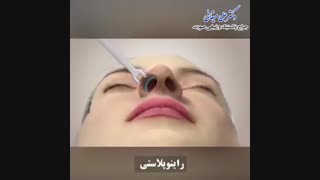 فیلم راینوپلاستی