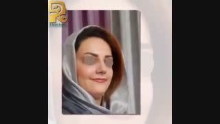 نتیجه جراحی رینوپلاستی پس از سه هفته