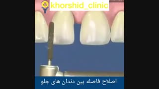 فیلم بستن فاصله بین دندانی