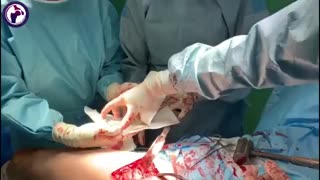 استفاده از کوچکترین پروتز مفصل ران جهت حفظ استخوان گردن ران