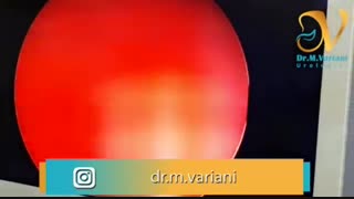 فیلم جراحی سنگ مثانه