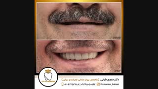 بازسازی کامل فک بالا بر پایه ایمپلنت در کلینیک دکتر منصور بابایی