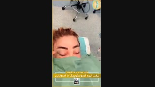 فیلم جراحی لیفت اندوسکوپیک ابرو