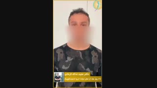 عمل جراحی لیفت اندوسکوپیک ابرو