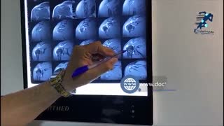 نماى پارگى (راپچر) عضله سینه اى بزرگ (پکتورالیس ماژور) در MRI