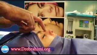جراحی بینی استخوانی قوزدار توسط دکتر امید ابراهیمی، بهترین جراح بینی استخوانی در تهران