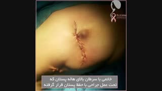 فیلم سرطان بالای هاله پستان