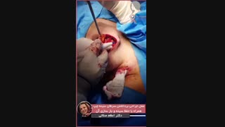 فیلم عمل جراحی سرطان سینه چپ