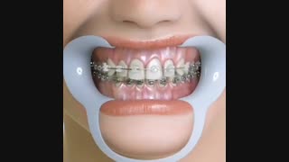 بهترین زمان درمان ارتودنسی