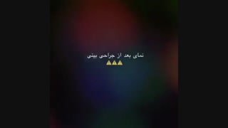 ویدئو جراحی حین عمل بینی به روش بسته