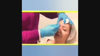 فیلم نحوه تزریق بوتاکس در نواحی پیشانی