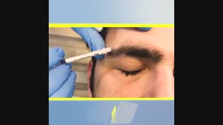 فیلم مزوتراپی ناحیه ابرو و ریش صورت