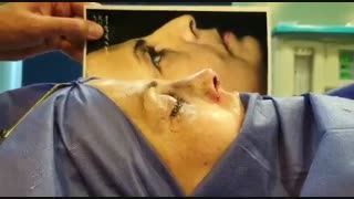 شش روز بعد از عمل بینی | دکتر امید ابراهیمی