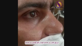 تزریق فیلر به زیر چشم
