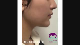 فیلم درمان لک و جای جوش با میکرونیدلینگ