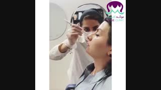 فیلم فرم دهی بینی با فیلر