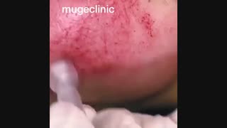 فیلم میکرونیدلینگ آر اف فرکشنال