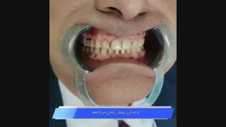 جایگزین کردن کامپوزیت با لمینیت