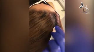 فیلم مزوتراپی موی سر