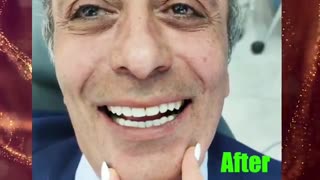 لمینیت دندانی