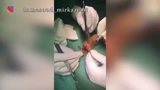 استفاده از پروتز میوالکتریک در دفورمیتی های اندام فوقانی و تومورها ی دست