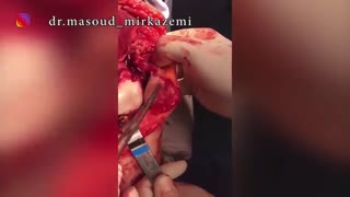 بیمار مبتلا به تومور سینویت پلی ویلندولار