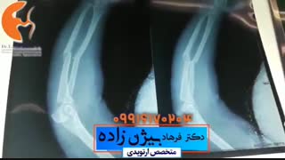 شکستگى دست و آرنج