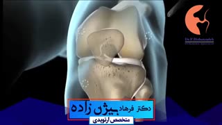 فیلم پارگى رباط صلیبی قدامی