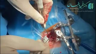جراحی میکروسکوپیک دیسک گردن