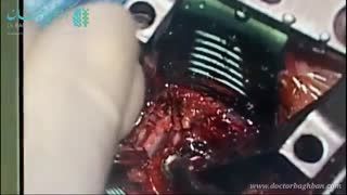 جراحی دیسک گردن در خانم میانسال