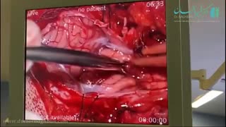 جراحی آنومالی مادرزادی کیاری تیپ 1