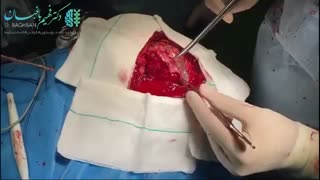 جراحی تومور مننژیوما
