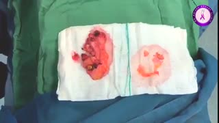 جراحی اصلاح ژنیکوماستی نامتقارن دردناک توسط دکتر مهدی آریانا