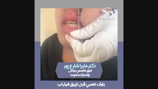 بلوک عصبی قبل از تزریق فیلر در لب