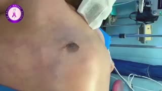 فیلم جراحی اصلاح ژنیکوماستی بسیار شدید - دکتر مهدی آریانا