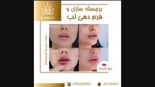 فیلم فرم دهی لب با ژل