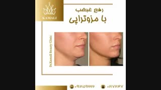 فیلم درمان غبغب با مزوتراپی