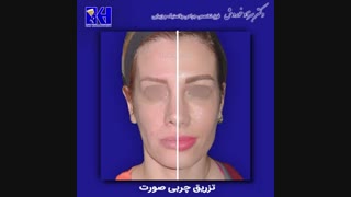 نمونه کار تزریق چربی به صورت